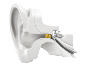 Lyric Hearing Aids at Happy Ears Hearing Center