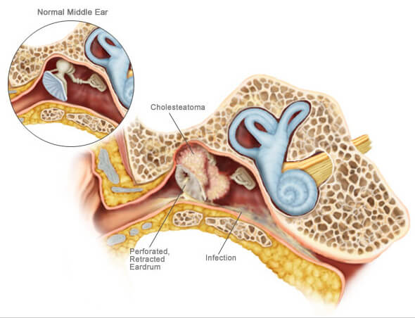 Cholesteatoma Symptoms, Treatment, and More – Happy Ears