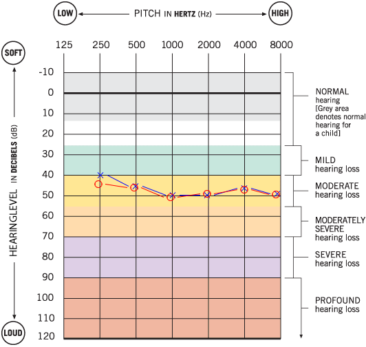 Hearing Loss Chart Db