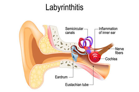 labyrinthitis ear inflammation