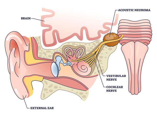 illustration of the ear and acoustic neuroma