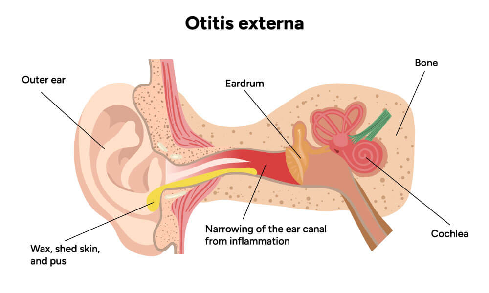 illustration of otitis externa