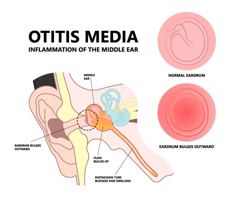 diagram of otitis media, inflammation of the middle ear