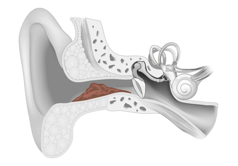 wax inside of an ear